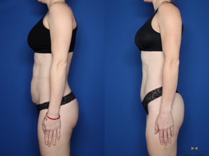Before & After Tummy Tuck Case 595 Left Side View in Fort Worth & Arlington, Texas