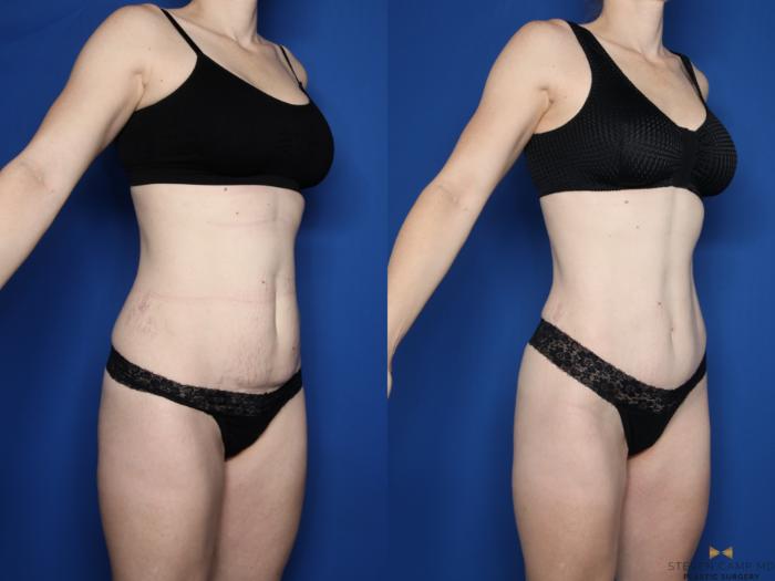 Before & After Tummy Tuck Case 595 Right Oblique View in Fort Worth & Arlington, Texas