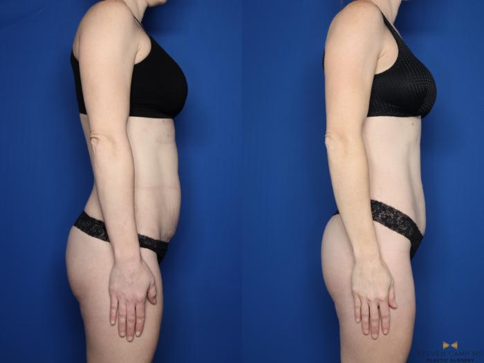 Before & After Tummy Tuck Case 595 Right Side View in Fort Worth & Arlington, Texas