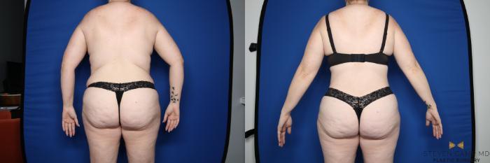 Before & After Liposuction Case 610 Back View in Fort Worth & Arlington, Texas