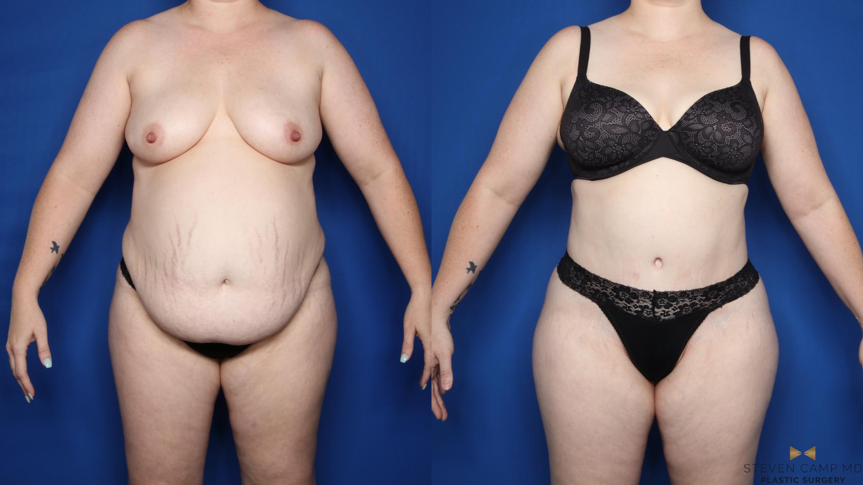 Before & After Liposuction Case 610 Front View in Fort Worth & Arlington, Texas