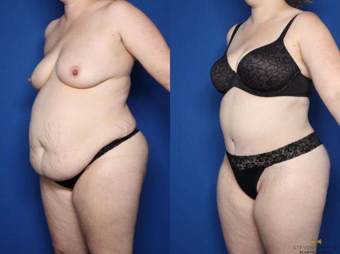 Before & After Tummy Tuck Case 610 Left Oblique View in Fort Worth & Arlington, Texas