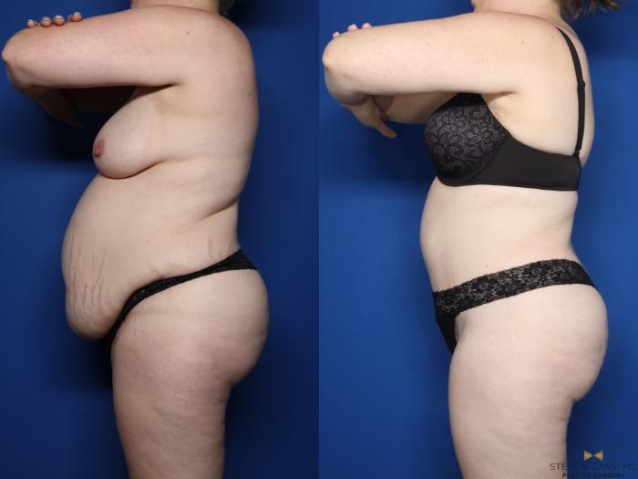 Before & After Tummy Tuck Case 610 Left Side View in Fort Worth & Arlington, Texas