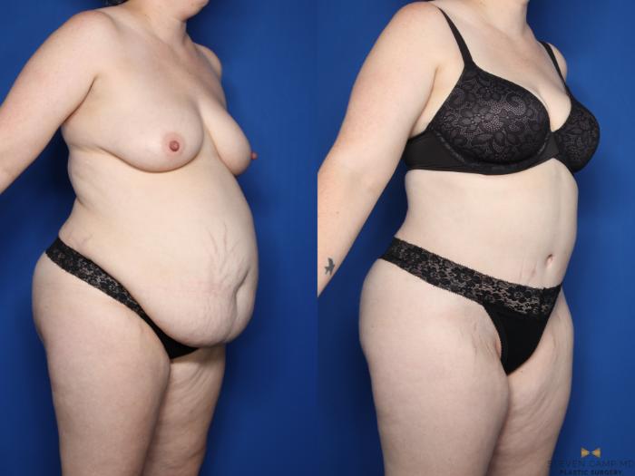Before & After Liposuction Case 610 Right Oblique View in Fort Worth & Arlington, Texas