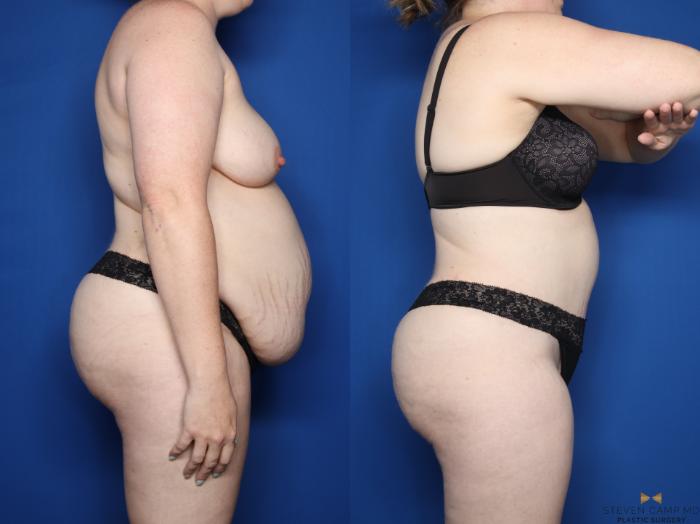 Before & After Tummy Tuck Case 610 Right Side View in Fort Worth & Arlington, Texas