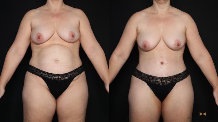 Before & After Tummy Tuck Case 611 Front View in Fort Worth & Arlington, Texas
