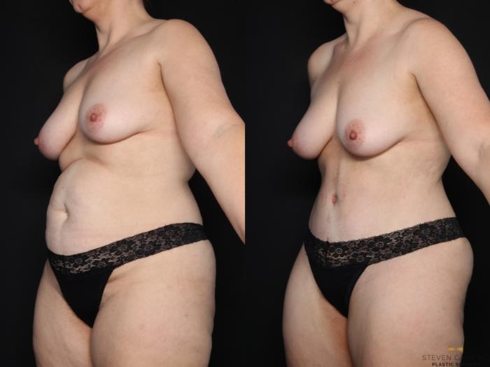 Before & After Tummy Tuck Case 611 Left Oblique View in Fort Worth & Arlington, Texas