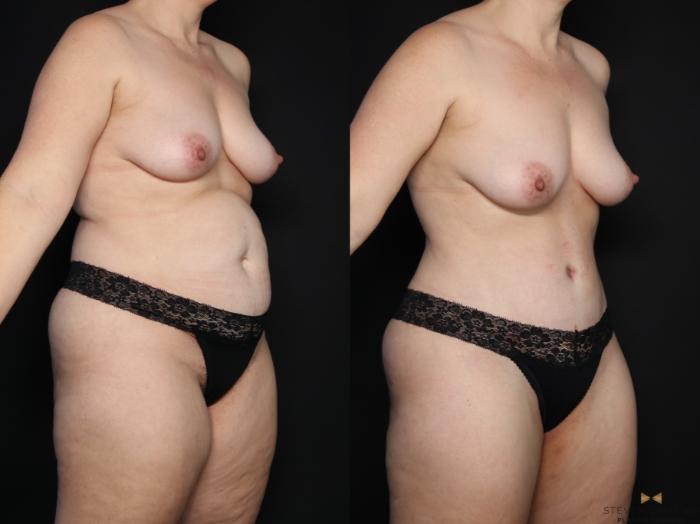 Before & After Tummy Tuck Case 611 Right Oblique View in Fort Worth & Arlington, Texas