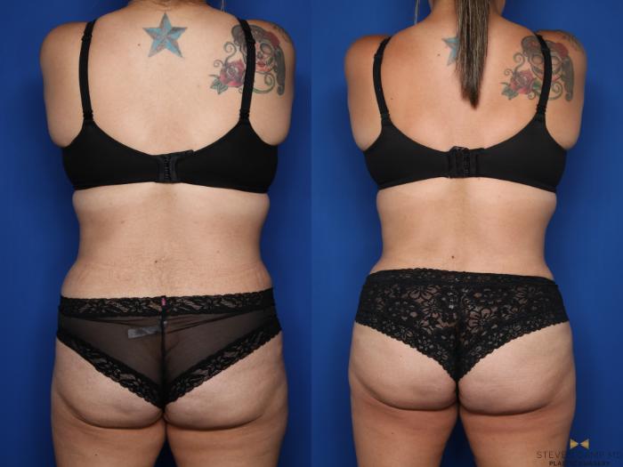 Before & After Liposuction Case 612 Back View in Fort Worth & Arlington, Texas