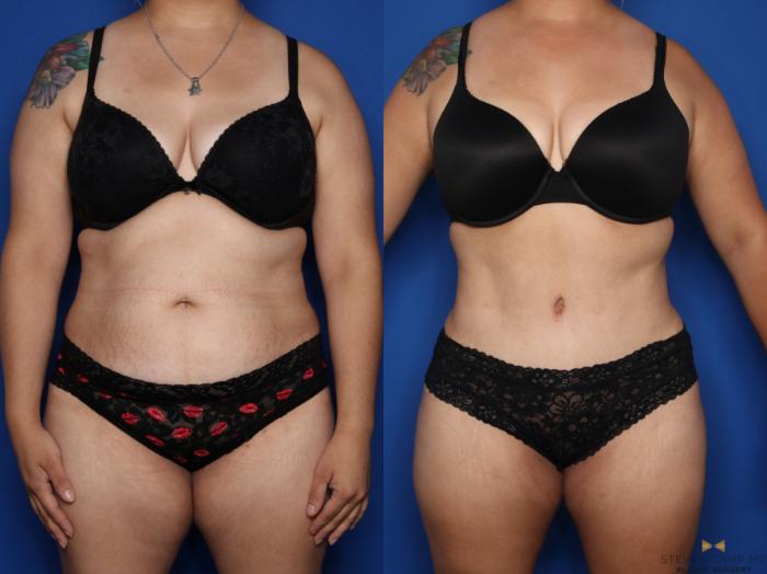 Before & After Tummy Tuck Case 612 Front View in Fort Worth & Arlington, Texas