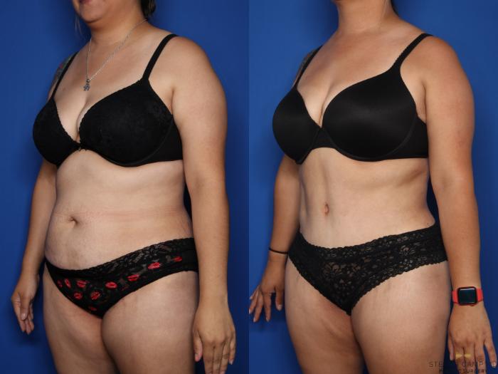 Before & After Tummy Tuck Case 612 Left Oblique View in Fort Worth & Arlington, Texas