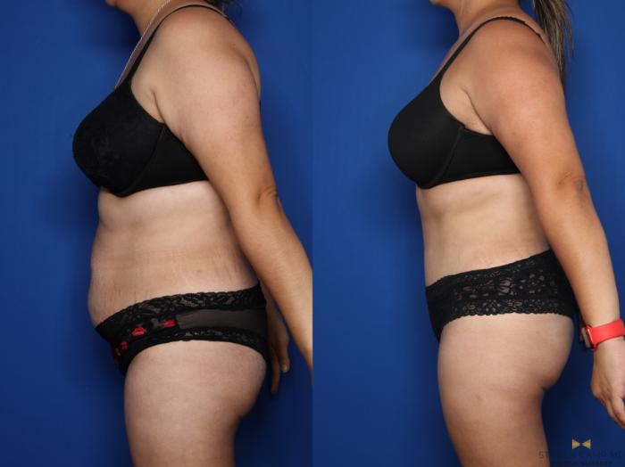 Before & After Tummy Tuck Case 612 Left Side View in Fort Worth & Arlington, Texas