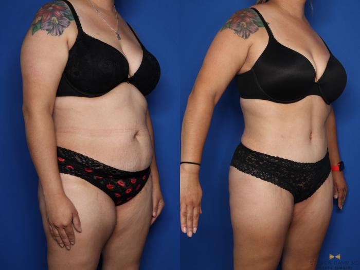 Before & After Liposuction Case 612 Right Oblique View in Fort Worth & Arlington, Texas