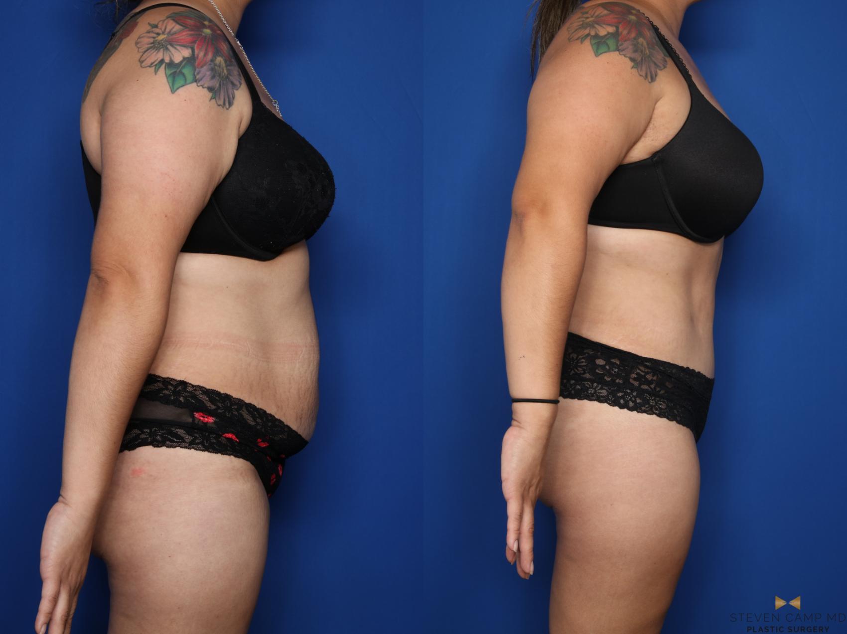 Before & After Tummy Tuck Case 612 Right Side View in Fort Worth & Arlington, Texas