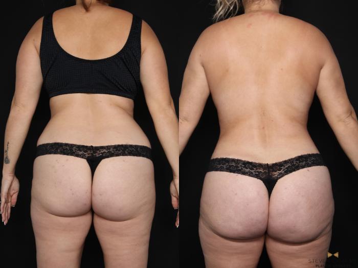 Before & After Liposuction Case 628 Back View in Fort Worth & Arlington, Texas