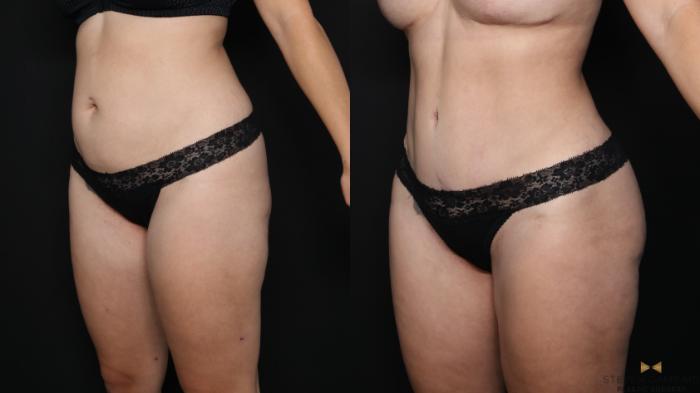 Before & After Tummy Tuck Case 628 Left Oblique View in Fort Worth & Arlington, Texas