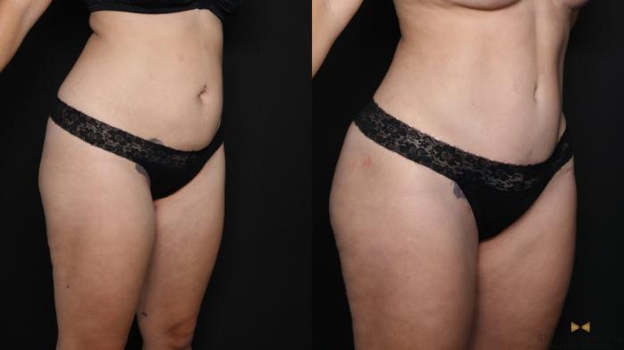 Before & After Tummy Tuck Case 628 Right Oblique View in Fort Worth & Arlington, Texas