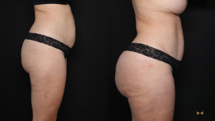 Before & After Tummy Tuck Case 628 Right Side View in Fort Worth & Arlington, Texas