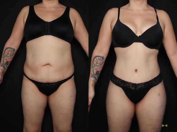 Before & After Tummy Tuck Case 656 Front View in Fort Worth & Arlington, Texas