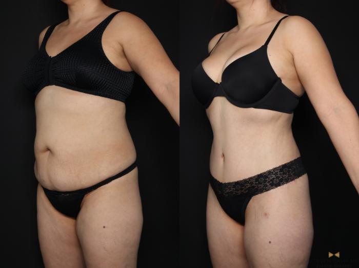 Before & After Tummy Tuck Case 656 Left Oblique View in Fort Worth & Arlington, Texas
