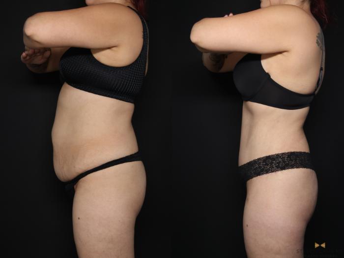 Before & After Liposuction Case 656 Left Side View in Fort Worth & Arlington, Texas