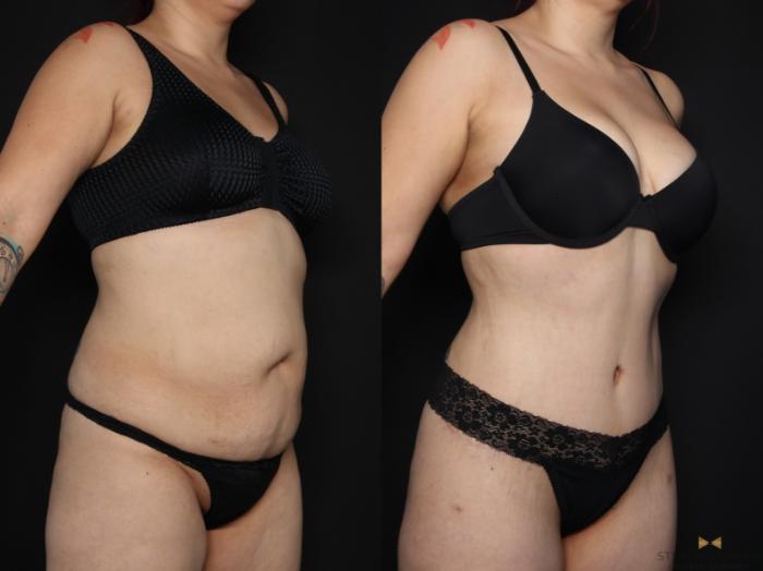 Before & After Tummy Tuck Case 656 Right Oblique View in Fort Worth & Arlington, Texas