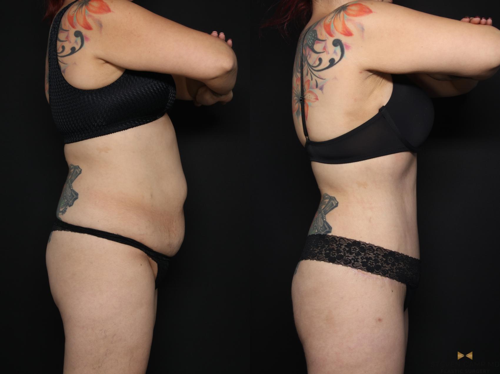 Before & After Tummy Tuck Case 656 Right Side View in Fort Worth & Arlington, Texas