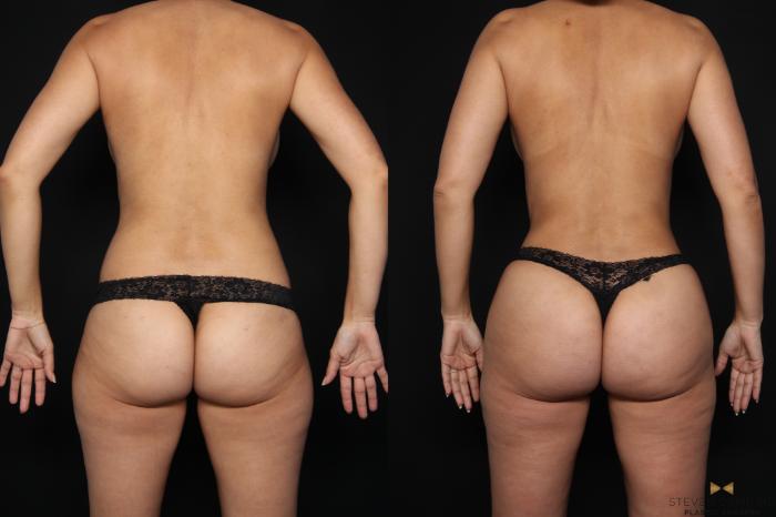 Before & After Liposuction Case 660 Back View in Fort Worth & Arlington, Texas