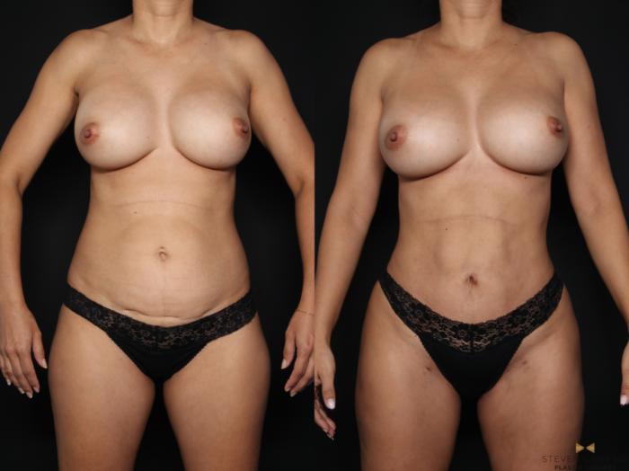 Before & After Liposuction Case 660 Front View in Fort Worth & Arlington, Texas