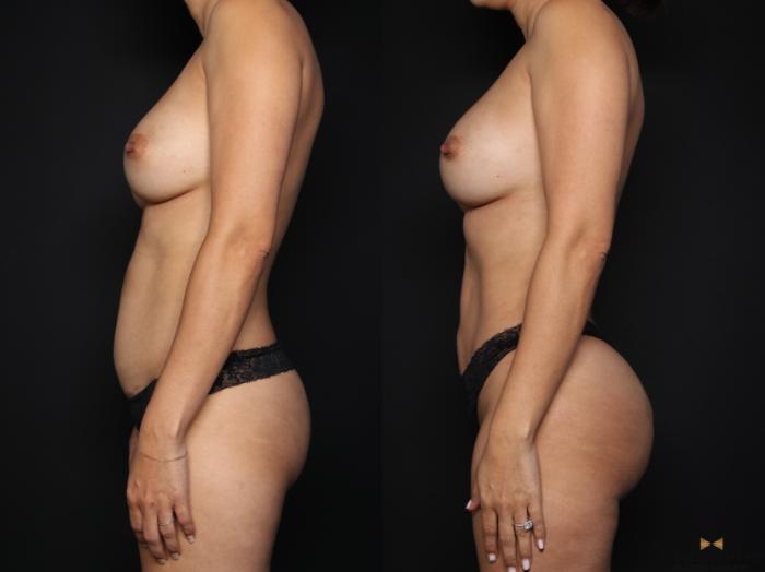 Before & After Tummy Tuck Case 660 Left Side View in Fort Worth & Arlington, Texas