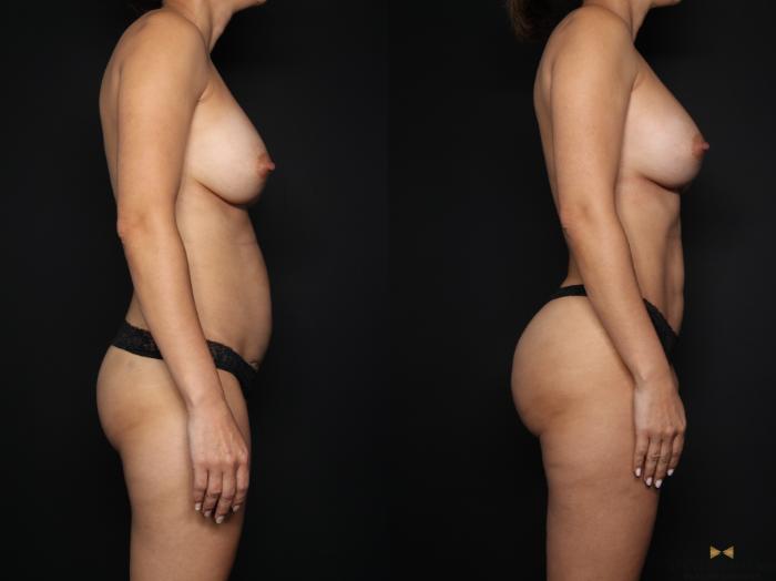 Before & After Tummy Tuck Case 660 Right Side View in Fort Worth & Arlington, Texas