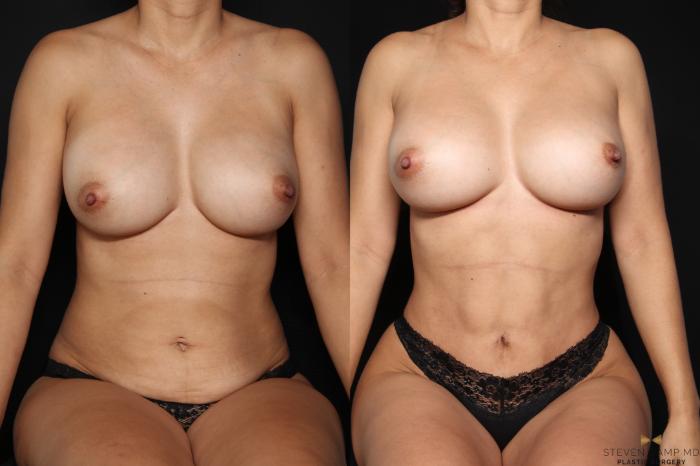 Before & After Tummy Tuck Case 660 Seated View in Fort Worth & Arlington, Texas