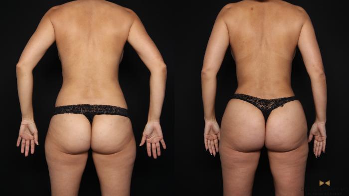 Before & After Liposuction Case 663 Back View in Fort Worth & Arlington, Texas