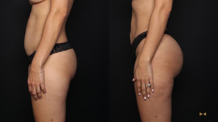 Before & After Brazilian Butt Lift Case 663 Left Side View in Fort Worth & Arlington, Texas