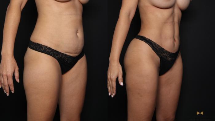 Before & After Brazilian Butt Lift Case 663 Right Oblique View in Fort Worth & Arlington, Texas