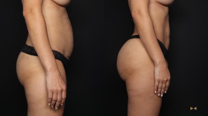 Before & After Liposuction Case 663 Right Side View in Fort Worth & Arlington, Texas