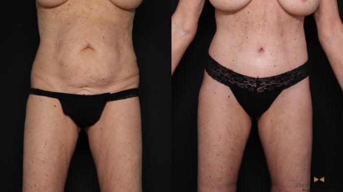 Before & After Tummy Tuck Case 679 Front View in Fort Worth & Arlington, Texas