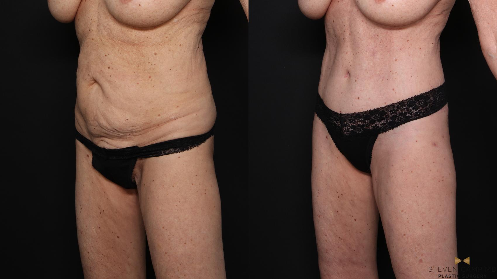 Before & After Tummy Tuck Case 679 Left Oblique View in Fort Worth & Arlington, Texas