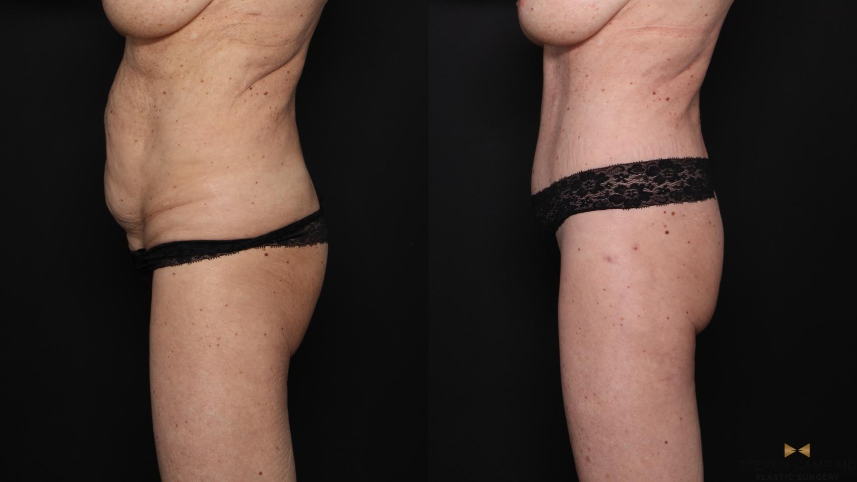 Before & After Tummy Tuck Case 679 Left Side View in Fort Worth & Arlington, Texas