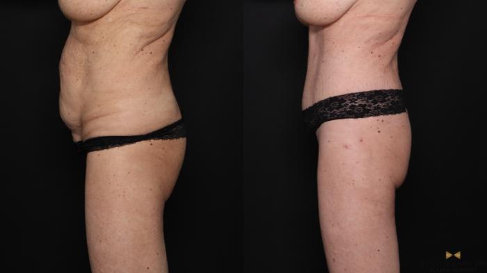 Before & After Tummy Tuck Case 679 Left Side View in Fort Worth & Arlington, Texas