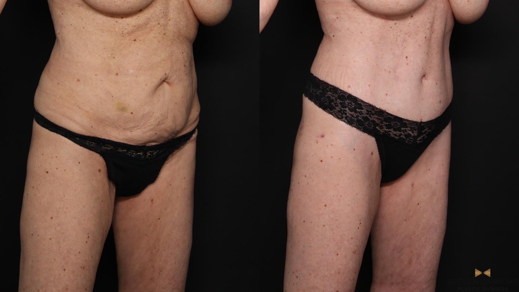 Before & After Tummy Tuck Case 679 Right Oblique View in Fort Worth & Arlington, Texas