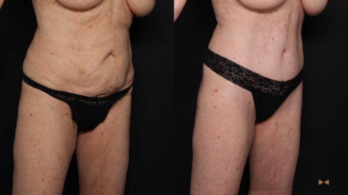 Before & After Tummy Tuck Case 679 Right Oblique View in Fort Worth & Arlington, Texas