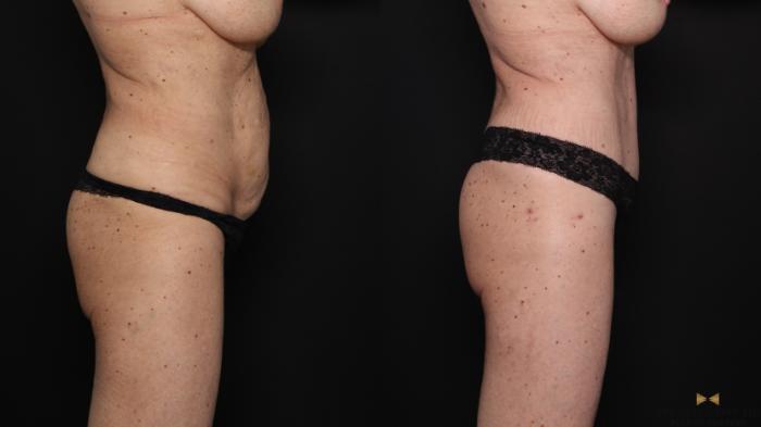 Before & After Tummy Tuck Case 679 Right Side View in Fort Worth & Arlington, Texas