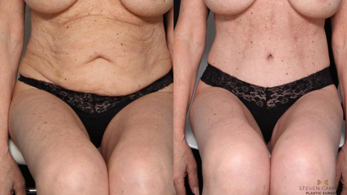 Before & After Tummy Tuck Case 679 Seated View in Fort Worth & Arlington, Texas