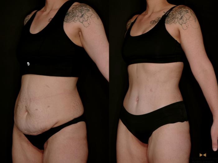 Before & After Tummy Tuck Case 736 Left Oblique View in Fort Worth & Arlington, Texas