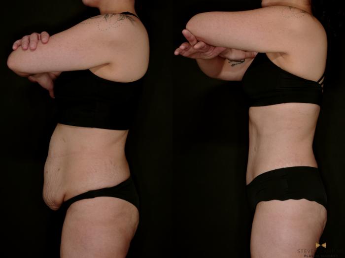 Before & After Tummy Tuck Case 736 Left Side View in Fort Worth & Arlington, Texas