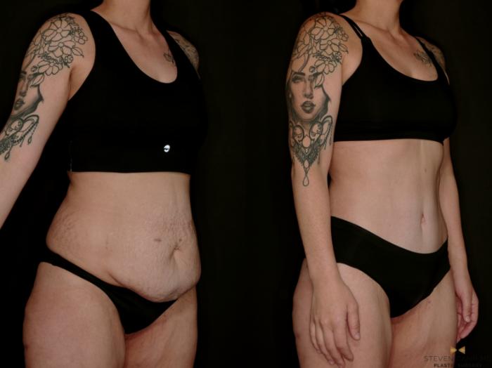 Before & After Tummy Tuck Case 736 Right Oblique View in Fort Worth & Arlington, Texas