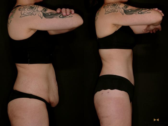 Before & After Tummy Tuck Case 736 Right Side View in Fort Worth & Arlington, Texas