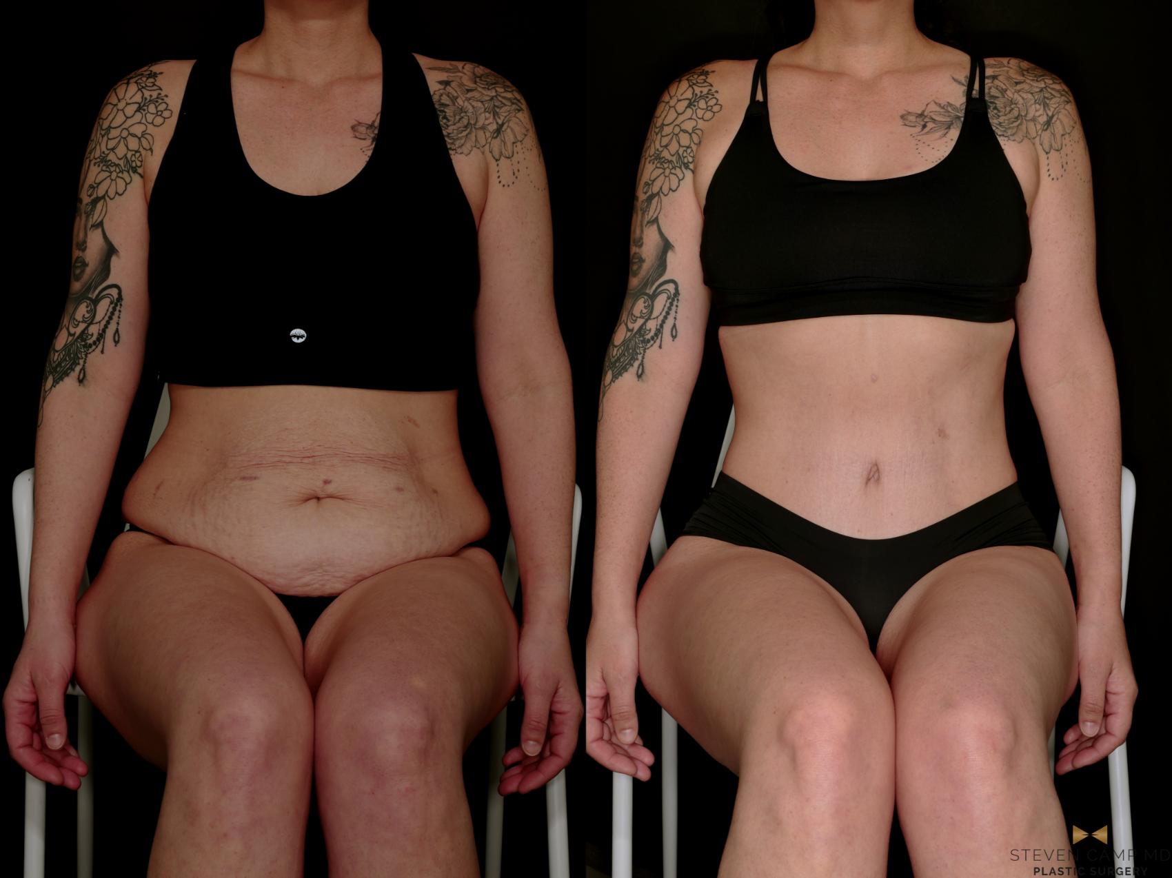 Before & After Liposuction Case 736 Seated View in Fort Worth & Arlington, Texas
