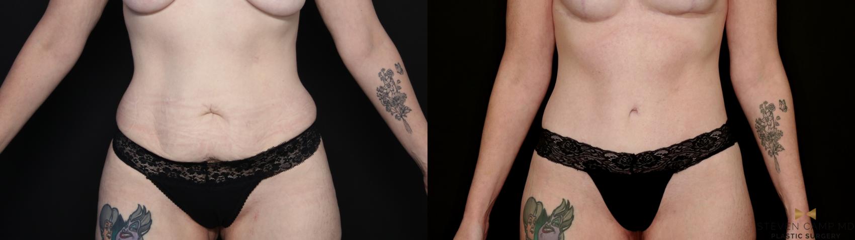 Before & After Tummy Tuck Case 738 Front View in Fort Worth & Arlington, Texas